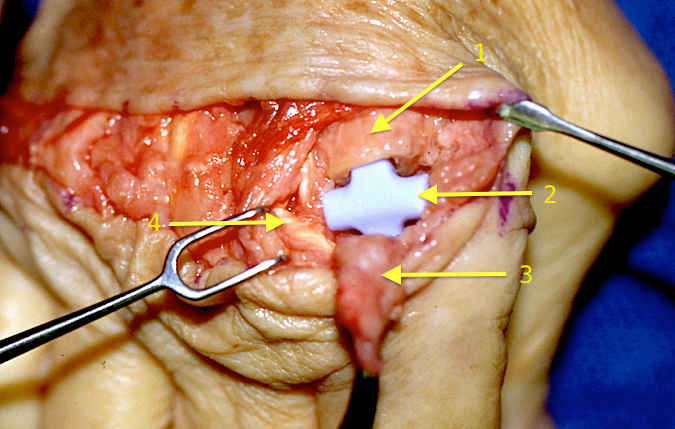 Index MP joint replacement for RA. (1) Metacarpal head, (2) Silicone prosthesis, (3) Joint capsule for later repair (4) Extensor tendon