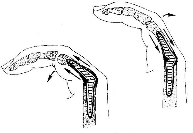 Index MP joint replacement for RA - Silicone prosthesis not attached to bone but flexes and pistons back and forth in bones to provide motion.