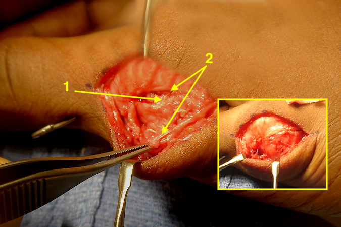 Right thumb MP joint torn radial collateral ligament and capsule repaired (1);  EPB tendon edge and abductor aponeurosis (2) before repair and after in insert.