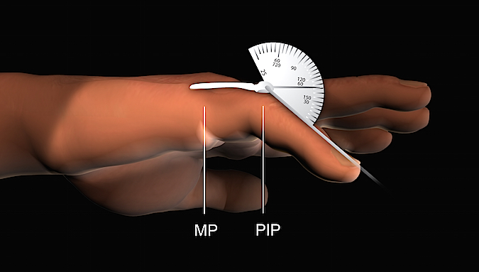 Measuring digital range of motion with goniometer.