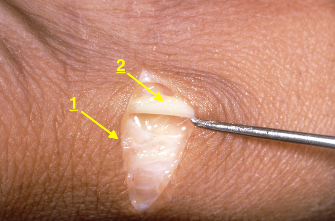 NEUROMA | Hand Surgery Resource