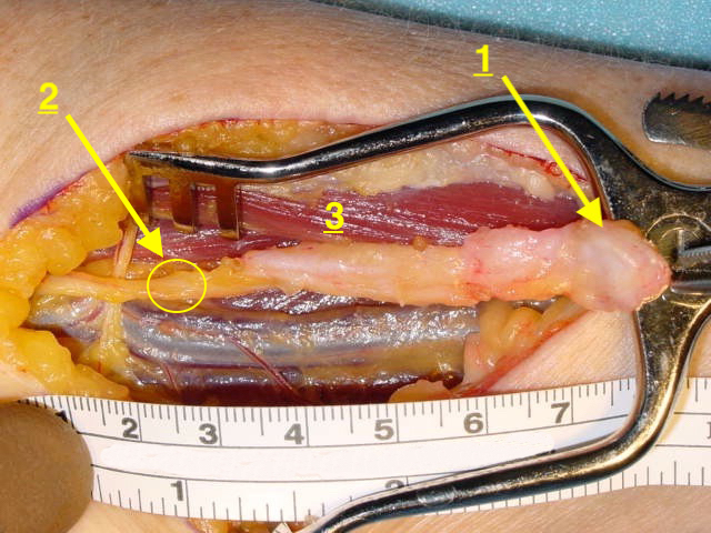 NEUROMA | Hand Surgery Resource