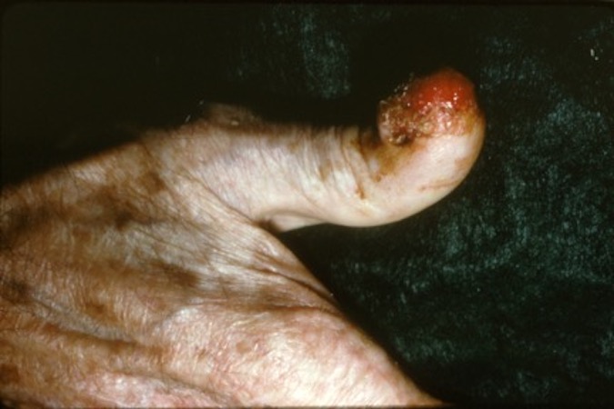 Saquamous Cell Carcinoma Right Thumb.