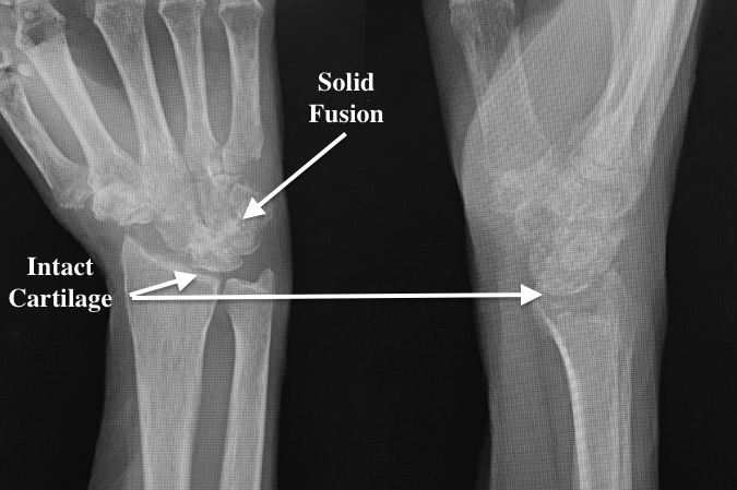 Solid 4 Corner Fusion at four months with cartilage between radius and lunate