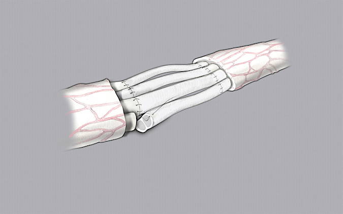 Median nerve laceration with true defect repaired with sural nerve grafts.