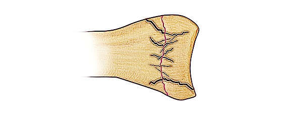 Salter V Fracture - A compression-type fracture line in the physis with extension in multiple directions. Growth plate (physis) damage is likely