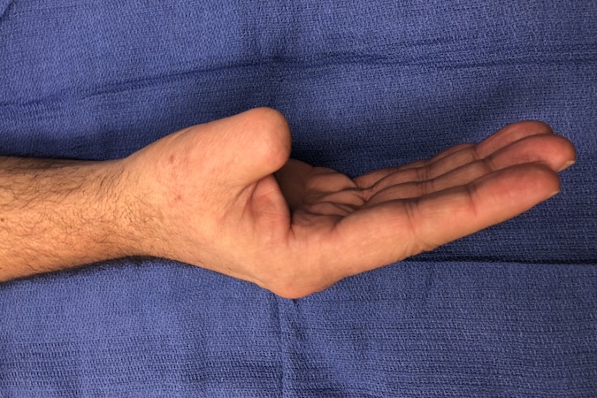 Post-operative photo right thumb 4 months after amputation for treatment of a subungual squamous cell carcinoma.