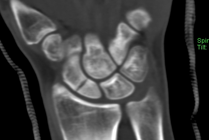 Cast treatment for mid third scaphoid fracture