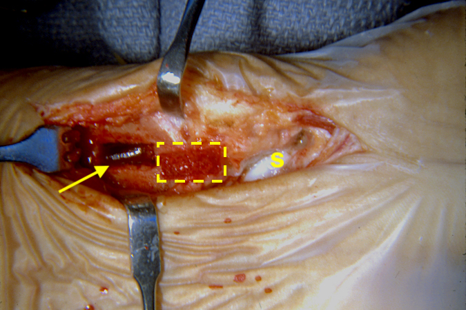 Scaphoid non-union donor site (arrow) with graft removed (insert) and scaphoid (S) exposed through the same volar surgical approach.