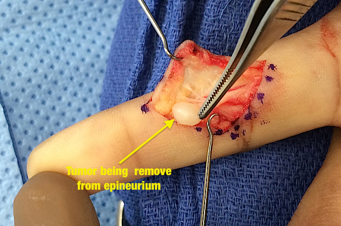 NEURILEMMOMA (SCHWANNOMA) | Hand Surgery Resource