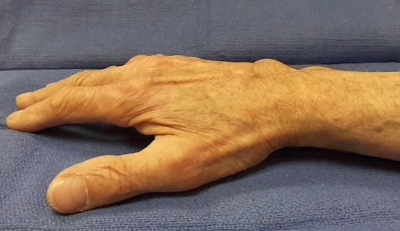 Dorsal wrist tenosynovitis.