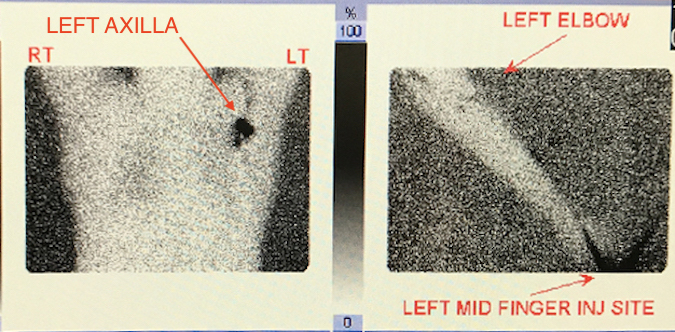 Imaging after injection for a sentinel node biopsy of patient with a subungual melanoma left long finger. Note uptake in left axilla.