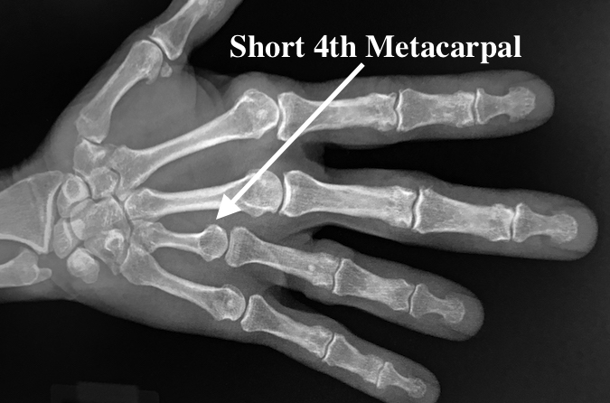 Brachydactyly - AP short 4th Metacarpal (arrow)