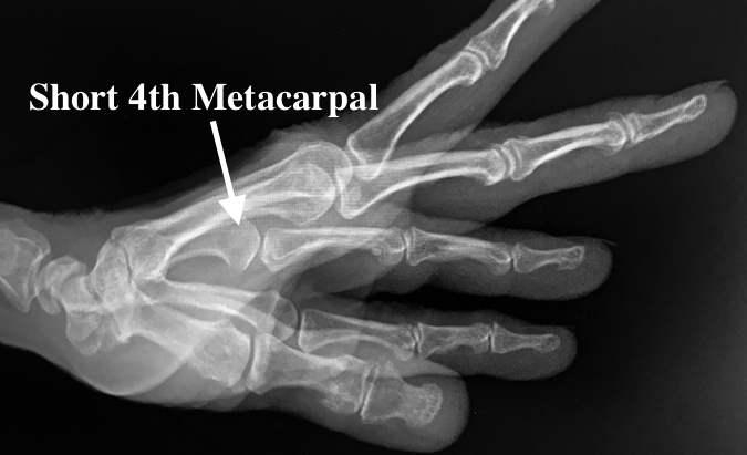 BRACHYDACTYLY | Hand Surgery Resource