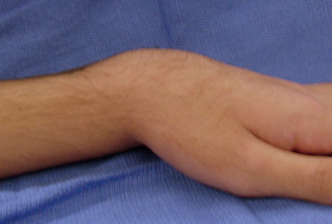 Silver Fork Deformity Secondary to Distal Radius Fracture.