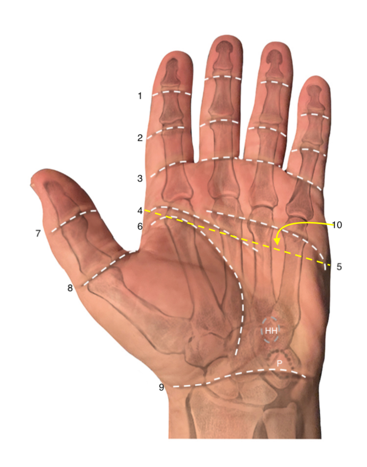 Creases: 1. Distal digital crease; 2. Middle digital crease; 3. Proximal digital crease; 4. Distal palmar crease; 5. Proximal palmar crease; 6. Thenar crease;   7. Distal thumb crease; 8. Proximal thumb crease; 9. Distal wrist crease; 10. Topographical line over the metacarpal necks.