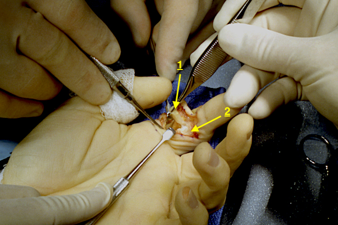 Swan neck deformity of the left index finger being repaired with a FDS slip (1) tenodesis. Note retracted FDP (2).