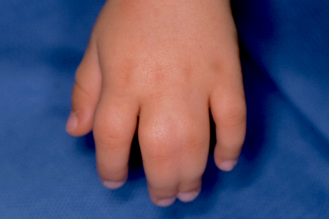 Simple Syndactyly Left Long and Ring Fingers Dorsal view.