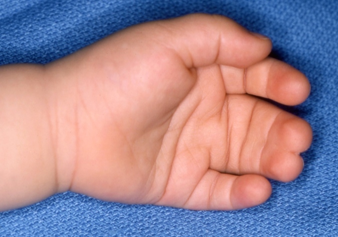 Palm view of classic Simple Syndactyly of left long and ring fingers