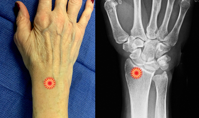 The red "tender" sign pin points the area of tenderness in relationship to the carpal bones, distal radius  and the dorsal wrist surface anatomy of a patient with  a potential Colles' Fracture.