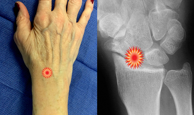 The red "tender" sign pin points the area of tenderness in relationship to the distal radius, scaphoid,S-L joint  and the dorsal wrist surface anatomy of a patient with  a SLAC Wrist.