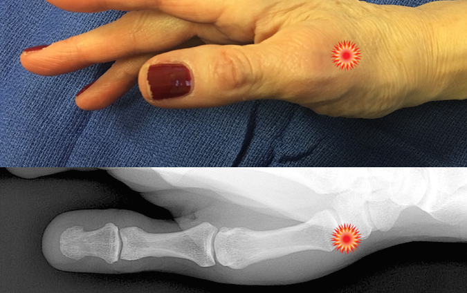 The red "tender" sign pin points the area of tenderness in relationship to the first metacarpal, trapezium, CMC joint and the surface anatomy of a patient with  thumb CMC OA.