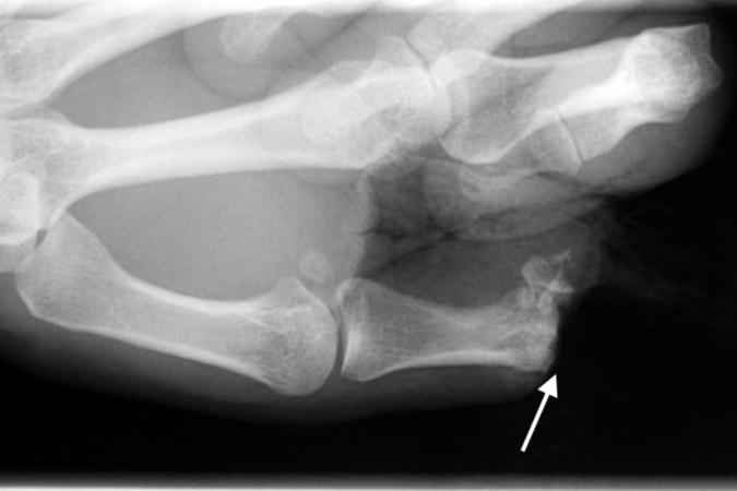 AMPUTATION, THUMB | Hand Surgery Resource