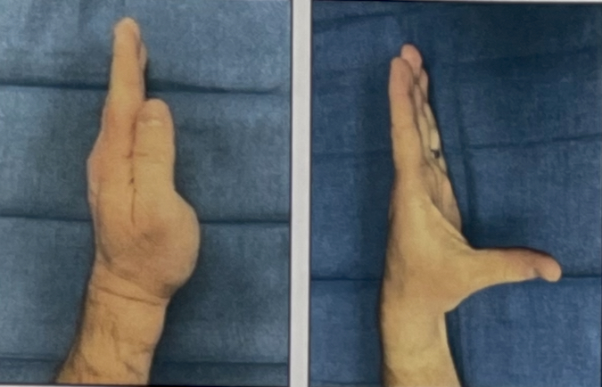 With the little finger side of your hand resting on the table, move thumb next to your index finger. Then move thumb out to the side away from your hand, forming an "L" shape. Continue to move your thumb back and forth between these two positions.