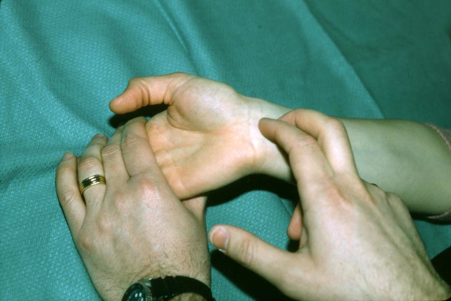 Tinel's Sign Median Nerve - This test is done by tapping on the median nerve just proximal to the wrist crease. The wrist is held in 30 degrees of dorsiflexion while the nerve is percussed. The wrist should be held loosely so that the patient doesn't tighten his volar ligaments and muscles during the test.