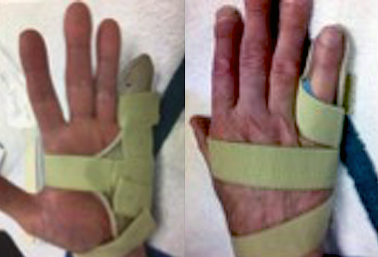 Resting finger extension splint for progressive night extension