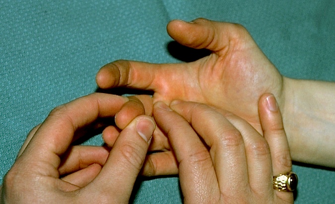 Palpating for A-1 flexor tendon pulley right long finger for tenderness.