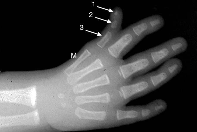 Hypoplastic triphalangeal thumb: 1.distal phalanx; 2.middle phalangeal; 3. proximal phalanx;  M-thumb metacarpal