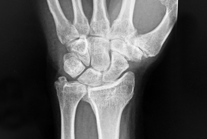 ULNAR IMPACTION SYNDROME (ULNAR CARPAL ABUTMENT) | Hand Surgery Resource