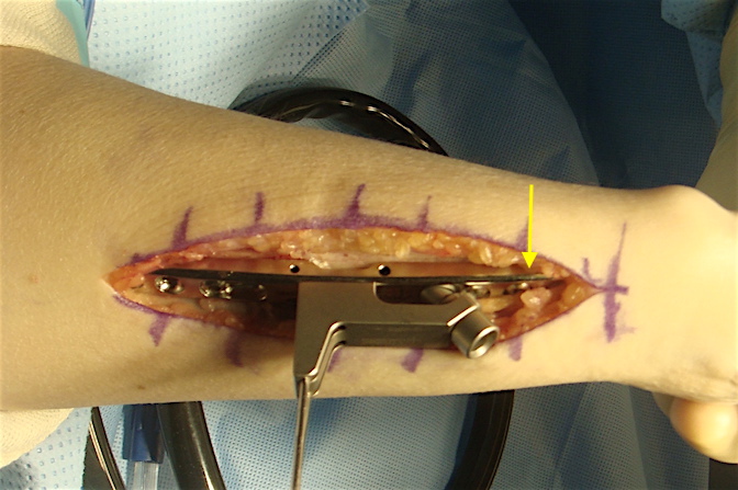 Plate secure with distal screws and a proximal screw in the slotted hole and ready for adjustment after shortening. Oblique screw guide held in p[lace with k-wires.