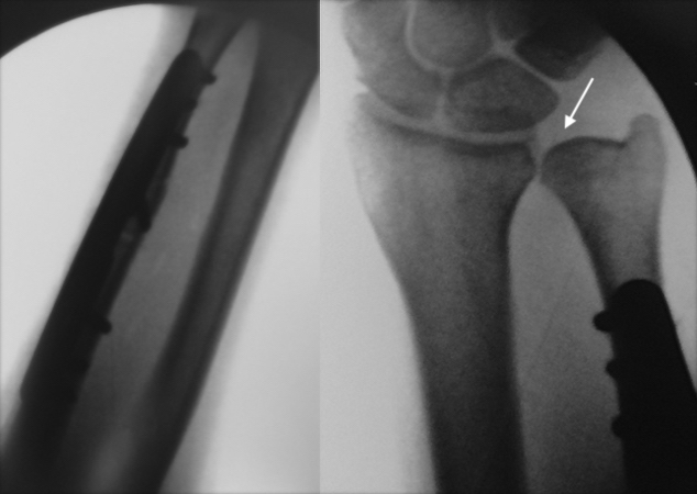 Final X-ray showing completed fixation and slight negative ulnar variance.