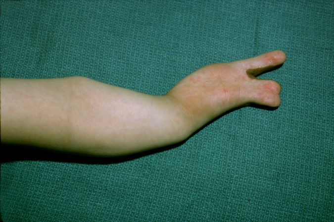 Ulnar Agenesis ( Congenital Ulnar Club Hand)