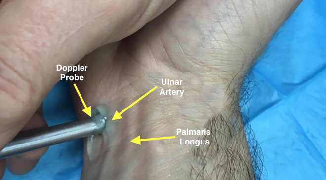 Palpating Ulnar Artery pulse at the wrist.