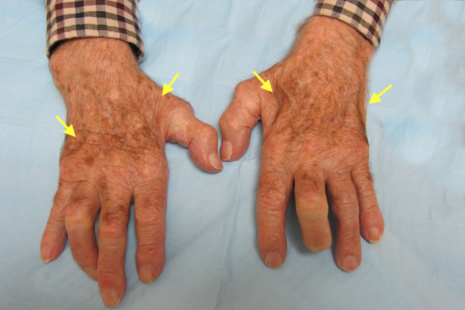 Marked bilateral ulnar intrinsic atrophy (arrows).