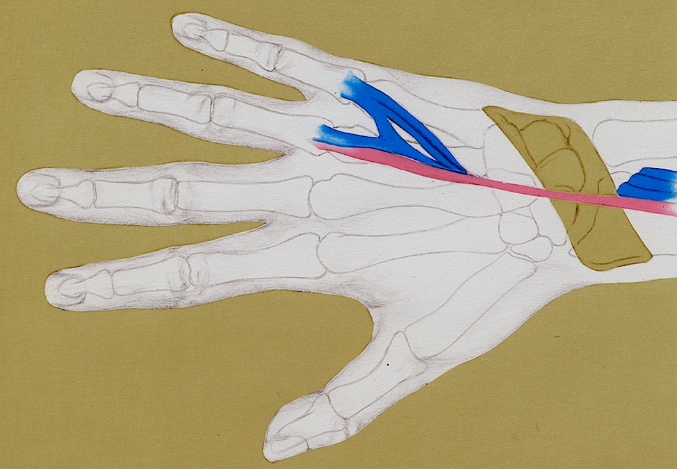 Vaughan-Jackson Syndrome Treatment by Adjacent Tendon Transfer