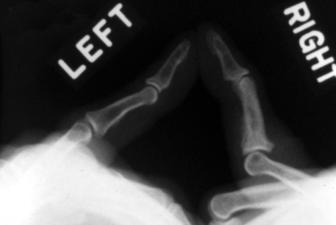 VOLAR PLATE RUPTURE | Hand Surgery Resource