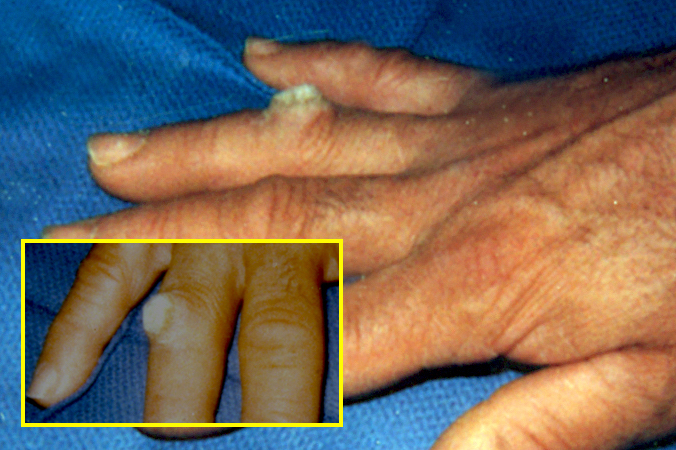 WART (VERRUCA VULGARIS) | Hand Surgery Resource