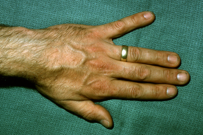 Wartenberg's Sign Left after ulnar nerve laceration.