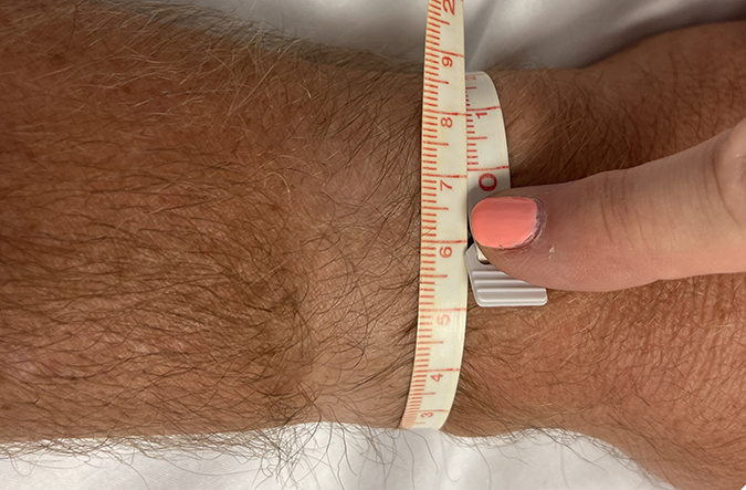 A simple tape measure can quantitate the circumference of a finger, thumb, palm, wrist or forearm. The measurement should be made at anatomic landmarks like the radial styloid. The measurements and landmarks can be document and followed over time and compared to measurements in the univolved extremity. 