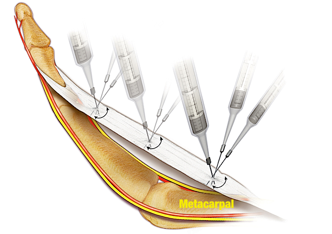 Needle Aponeurotomy in progress