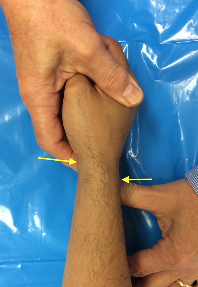 Ballottement Test for LT Ligament Laxity.