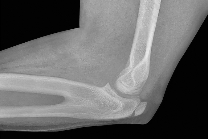 Congenital radioulnar synostosis Wilkie Type I with no proximal radius.