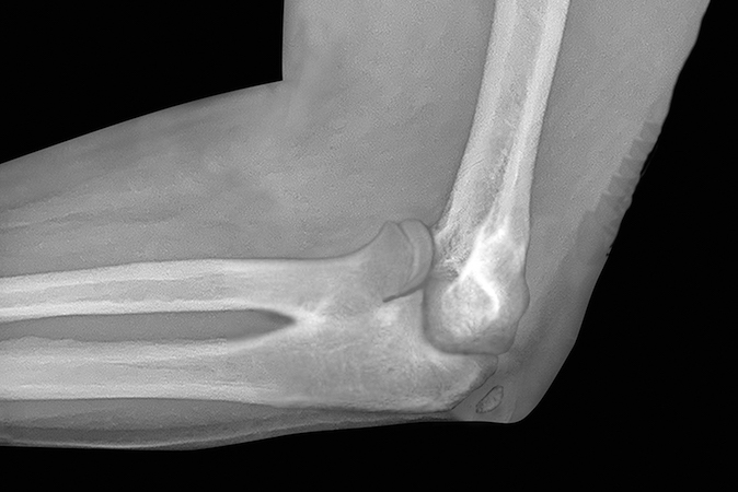 Congenital radioulnar synostosis Wilkie Type II with a proximal radius present.