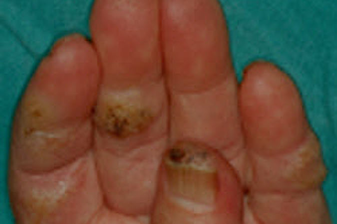 Wart (Verruca Vulgaris) multiple in immunocompromised patient.